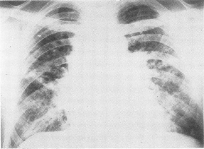 Snímek hrudníku zobrazující difuzní, oboustranné, retikulo-nodulární plicní onemocnění (“Vineyard sprayer's lung). Kredit: J. C. Pimentel a F. Marques, University of Lisbon. Další obrázky ZDE. https://thorax.bmj.com/content/thoraxjnl/24/6/678.full.pd