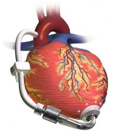 Podporné čerpadlo pre ľavú srdcovú komoru (LVAD)