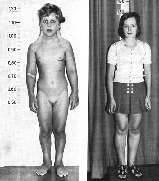 Turnerův syndrom (vpravo stav pacientky po kosmetické operaci). 